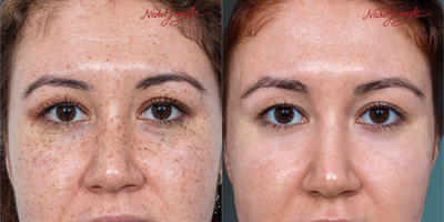 25-34 Years Old Woman Treated with PicoSure - Our patient's freckles; which are disappeared with the effect of the Pico Laser treatment; final state.