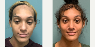 18-24 year old gender nonconforming person treated with Forehead Reduction, Transgender Facial Feminization Surgery, Facial Femi - This is a young lady who underwent forehead reconstruction, septorhinoplasty, and mandible reduction, and adams apple reduction. Lip lift is 2 months post op.