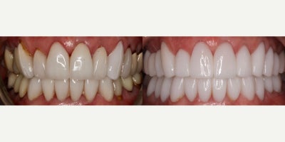 Woman treated with Smile Makeover - Function, health, and aesthetics are the trifecta in creating the perfect smile makeover.Its not solely about a picture perfect smile, but one that you can be sure lasts, functions, and is good for your overall health.Smile makeover is kinder to the tissue. The gums are less red, the recession is covered, and the materials is all porcelain-no metal!