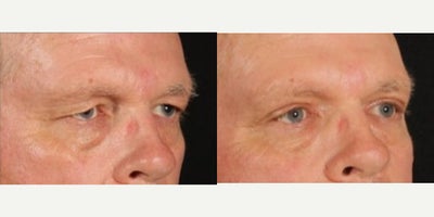 55-64 year old man treated with Eyelid Surgery - Our patient is healing up from his upper blepharoplasty just six weeks after his surgery. We are shooting for two things: improve eye strain and fatigue from heavy upper eyelids and get a more youthful, alert look. He is already on to bigger and better things. Thank you to him for allowing us to share!