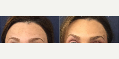 Woman treated with Botox - Woman treated with Botox
