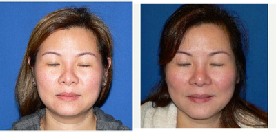 35-44 year old woman treated with Revision Rhinoplasty - This patient had rhinoplasty with silicone implant placement elsewhere. She wanted a softer look for her nose and wanted the implant revised. She opted to have the implant removed and have a DCF (diced cartilage fascia) graft placed instead.