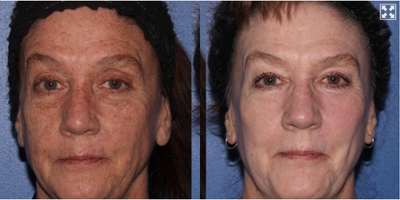55-64 year old woman treated with Scar Removal, Laser Scar Removal - Full face laser resurfacing