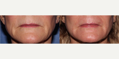 Woman treated with Scar Removal, Laser Scar Removal - Woman treated with Laser Resurfacing