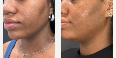 Woman treated with SkinPen, VI Peel - This client wanted to improve her skin texture, pores, and hyperpigmentation so we did a series of 1 SkinPen Microneedling, 1 Vi Peel Precision Plus, and 1 Hydrafacial 4 weeks apart between treatments!