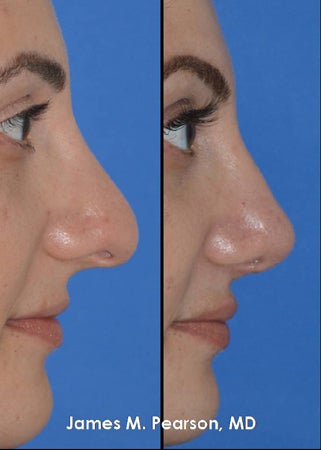 Rhinoplasty / Nasal Surgery - 
	Revision Rhinoplasty / Nasal Surgery
