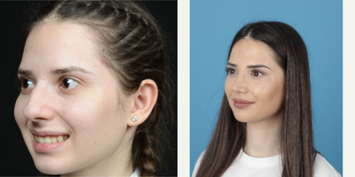 25-34 year old woman treated with Rhinoplasty - long term rhinoplasty results