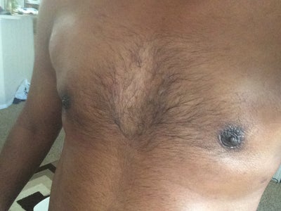 29 Year Old Gynecomastia Surgery In Bangalore India Done By Dr