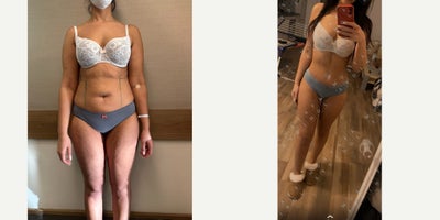 25-34 year old woman treated with Lipo 360, Renuvion - 25-34 year old woman treated with Lipo 360, Renuvion. Also had liposuction and Renuvion for arms and thighs.