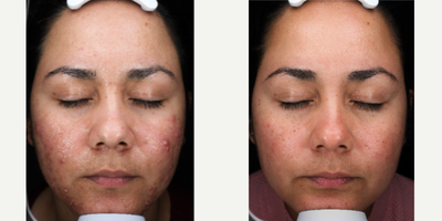 33 year old woman treated with VI Peel, Accutane for Active Acne - 33 year old female treated with Vi Peel Precision+ Accutane for Active Acne. Here are her 5 Month post-op results.