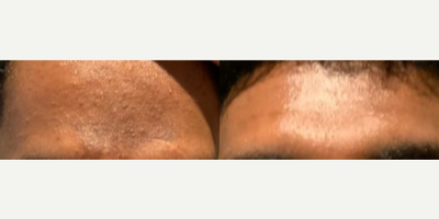 Woman treated with VI Peel - Woman treated with VI Peel, Skin Rejuvenation