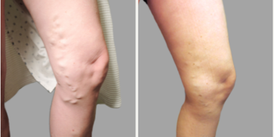 35-44 year old woman treated with VenaSeal - Chronic venous insufficiency