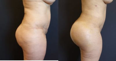 35-44 year old woman treated with Brazilian Butt Lift Revision - The patient had a previous Brazilian Butt Lift in Florida. She wanted to further improve her overall figure and increase the projection of her butt. We did a Brazilian Butt Lift Revision with SAFELipo to transform her from square to an hourglass figure. She also had fat transfer to the buttock and hips. The projection of her butt was done with 548cc butt implants. The combination of the liposculpting, fat transfer and butt implants gives her an amazing figure and butt!