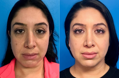 35-44 year old woman treated with FaceTite - 39 year old woman treated with FaceTite done in office under local anesthesia