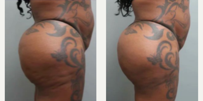 Woman treated with Aveli - Woman treated with Aveli. Patient shown before and 28 days post-op.
