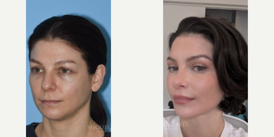 Woman treated with Lip Lift - Woman treated with Facelift, Lip Lift, Eyelid Surgery through upper eyelid blepharoplasty and skin pinch, temporal Brow Lift, Facial Fat Transfer, and Rhinoplasty. Patient is shown before and a few years after.