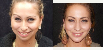 25-34 year old woman treated with Chin Surgery - Chin Surgery by Dr Zacharia