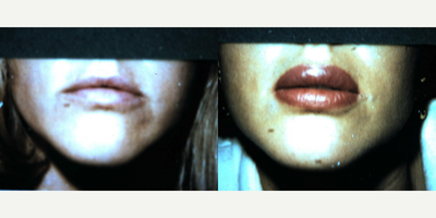 18-24 year old woman treated with Lip Surgery - A triple V to Y mucosal advancement was performed on the upper lip, and a double V to Y mucosal advancement was performed on the lower lip.
