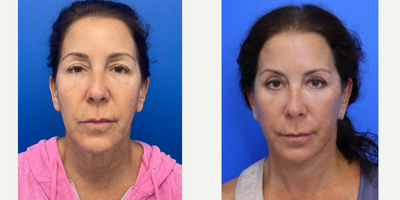 55-64 year old woman treated with Facelift, Neck Lift, Eyelid Surgery, Facial Fat Transfer, Laser Resurfacing - 57 year old patient 4 months after a Facelift, Neck lift, Upper and lower eyelid blepharoplasty, facial fat transfer and co2 laser.