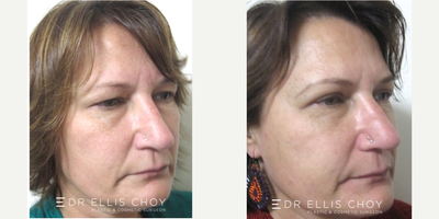 45-54 year old woman treated with Eyelid Surgery - Upper Blepharoplasty