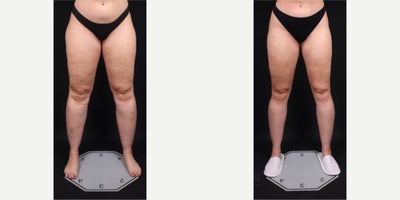 25-34 year old woman treated with Lipedema Surgery, Liposuction, Tumescent Liposuction - My stage 2 Lipedema patient came to me feeling frustrated with painful legs and struggling with low self-esteem. Despite her dedication to a strict diet and exercise, she hadnt found any solutions. In her before photos, you can see visible bruisinga telltale sign of Lipedema.Fast forward to now: 6 months after her surgery with Dr. Aria, she is absolutely thrilled with her transformation! She feels more balanced and confident, has experienced a remarkable improvement in her mental well-being.