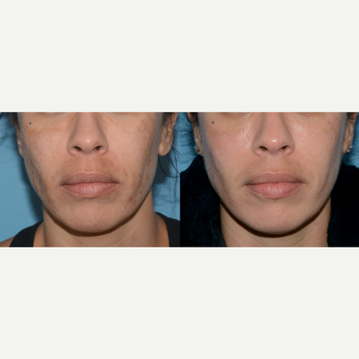 35-44 year old woman treated with LED Skin Treatment - Red and Blue light LED therapy