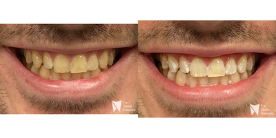 25-34 year old man treated with Zoom Whitening - 25-34 year old man treated with Zoom Whitening, shown immediately after the treatment.The white spots were present prior but are more exaggerated after treatment.