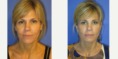 48 year old woman treated with Lower Face Lift - 48 year old female who did not like the laxity to her jaw and neck line. She had a FACEology Lift or Lower Facelift under local anesthesia and oral sedation. Note the natural lift in her jaw and neck line.