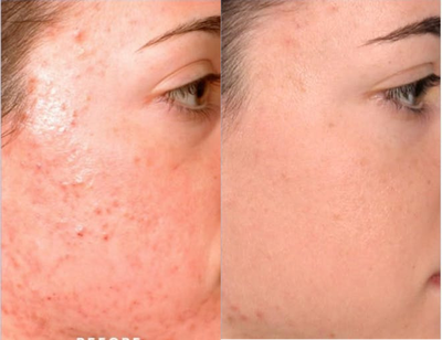 Woman treated with Dermalinfusion - Woman treated with Dermalinfusion