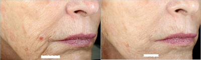 Woman treated with Vivace - Woman treated with Vivace