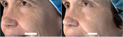 Woman treated with Vivace - Woman treated with Vivace
