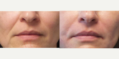 35-44 year old woman treated with Juvederm, Radiesse, Vollure, Restylane, Bellafill - Treatment of nasolabial folds (laugh lines) & marionette lines with Juvederm, Radiesse, Vollure, Restylane or Bellafill injected with cannula