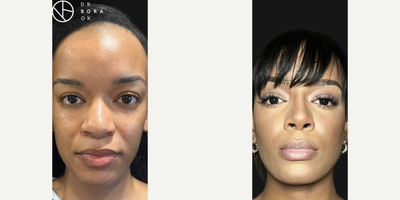 Woman treated with Rhinoplasty, African American Rhinoplasty - Now, thats a change that will make anyone go Wow! So elegant yet so natural. Check the glowing transformation achieved with bridge augmentation using cartilage grafts. Nine months post-op, our patient now has a naturally refined and well-proportioned nose. The enhanced nasal bridge adds a rejuvenating touch to her appearance.