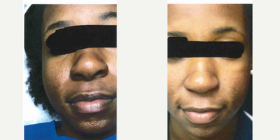 18-24 year old woman treated with Skin Lightening ZO Skin Health products - Young female with hyperpigmentation on a series of Retinol skin brighteners and Hydroquinone products.