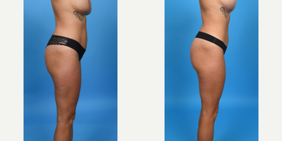 35-44 year old woman treated with Abdominal Etching, Diastasis Recti Repair, Liposculpture, Liposuction, Liposuction Revision, M - This patient was not happy with her tummy tuck done by another surgeon.  I did a revision tummy tuck.  I lowered her scar using a bikini incision, did vaser ultrasound liposuction of her abdomen and waist, removed excess skin and re-plicated her abdominal muscles.