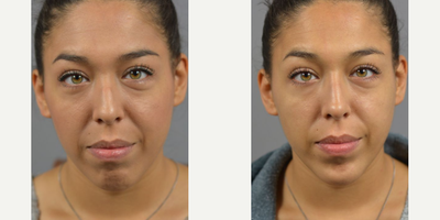 Woman treated with Chin Filler - Facial Asymmetry and contour is natural and makes each face unique. While most imperfections go unnoticed by the outside world. Often times we treat with surgical interventions but for a temporary adjustment with just as much impact the use of Botox and Filler can be used. Non-surgical Rhinoplasty by Dr. James Marotta complimented by filler injections to the chin.