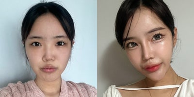 25-34 year old woman treated with Double Eyelid Surgery, Ptosis Surgery, Canthoplasty, Rhinoplasty - 25-34 year old woman treated with Double Eyelid Surgery, Ptosis Surgery, Canthoplasty, Rhinoplasty
