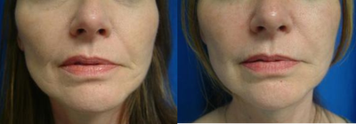 Artefill - This patient is a 55 year old professional woman was looking for a long term filler for her nasolabial folds and marionette lines. She opted for Artefill. Her after photo was taken 4.5 years after her Artefill treatment.