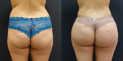 18-24 year old woman treated with Butt Augmentation - Woman treated with Brazilian Butt Lift. female BBL patient