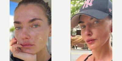 25-34 year old woman treated with PRF Treatment - Model Alina Baikova treated her hyperpigmentation with PRF. PRF can address many skin concerns and promote a healthy, rejuvenated appearance.