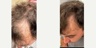25-34 year old man treated with PRF Treatment, PRP for Hair Loss - PRF for hair loss, especially when combined with exosomes, can stimulate new hair growth extremely effectively. Took a look at this impressive results!