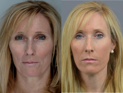 45-54 year old woman treated with Sculptra - Sculptra injected into right and left cheeks.