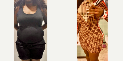 35-44 year old woman treated with Tummy Tuck, Liposuction, Brazilian Butt Lift - Excellent outcome after full tummy tuck combined with intense liposuction including abdomen, waist, laterals and upper and lower back to improve your body contour and get better curves, especially in your waist area and dominican butt lift.