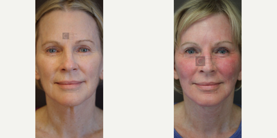 Woman treated with Fractional Laser - Woman treated with CO2 FractionalLaser Resurfacing as well as Facelift and Neck Lift. Pre-op, she was bothered by the early aging changes along her jawline, neck, and around her eyes.