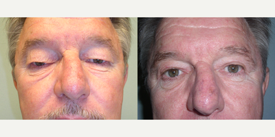 65-74 year old man treated with Eyelid Surgery - 65-74 year old man treated with Eyelid Surgery. This patient had his upper and lower eyelids rejuvenated
