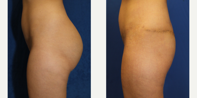 25-34 year old woman treated with Silicone Injection Removal - Meet our patient, a 30-year-old female standing at 5'4 and weighing 122 pounds. In 2017, she underwent two rounds of silicone injections in her buttocks in Las Vegas, NV, which resulted in pain and discomfort.In search of a solution, she consulted with the exceptional Dr. J. Timothy Katzen in Beverly Hills, CA, who suggested silicone removal, posterior bodylift, and bilateral lymph node removal. The three-hour-long surgery was successful in removing 2.76 pounds of silicone, skin and fat, and improving the overall health and appearance of her buttocks.We are delighted to hear that the patient is feeling good after her surgery. It's inspiring to see how cosmetic procedures can help individuals not just achieve their desired appearance but also improve their quality of life.We wish her continued health and happiness and applaud her for taking the necessary steps towards achieving her goals.
