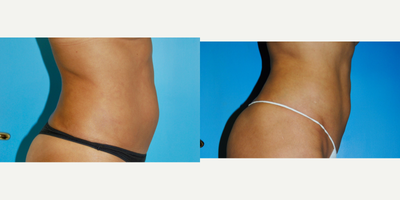 45-54 year old woman treated with UltraSlim - Ultraslim treatment