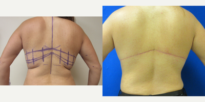 Upper Back Lift - Patient wanted to get rid of her back rolls, loose skin and deep grooves.  Dr. Eric Schaffer performed an upper back lift to accomplish this patients goals.  Post op pictures are only one month post op and the incisions will continue to lighten.