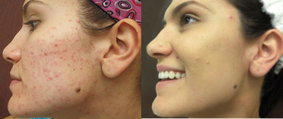 23 year old woman treated with Vi Peel - This patient had a Vi peel and Microdermabrasion treatment for her acne