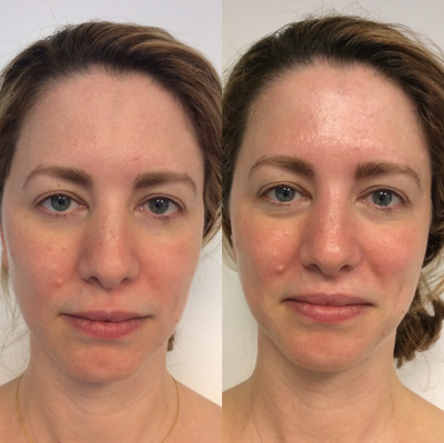 25-34 year old woman treated with HydraFacial - HydraFacial immediately plumps, lifts and defines the jawline including lymphatic drainage.
